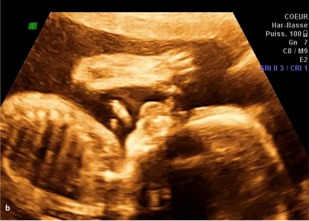 m/سونوگرافی آنومالی چیست؟