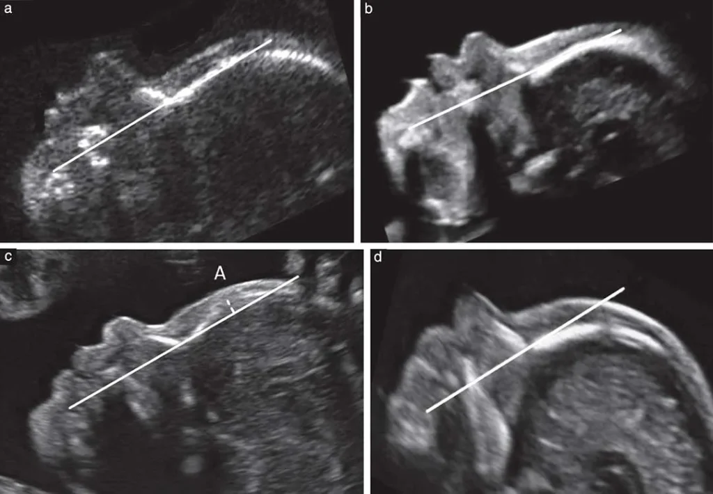 m/سونوگرافی NB تهران